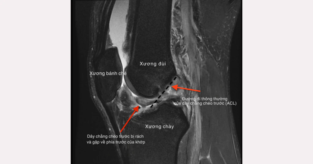 chẩn đoán tổn thương dây chằng chéo trước (ACL)