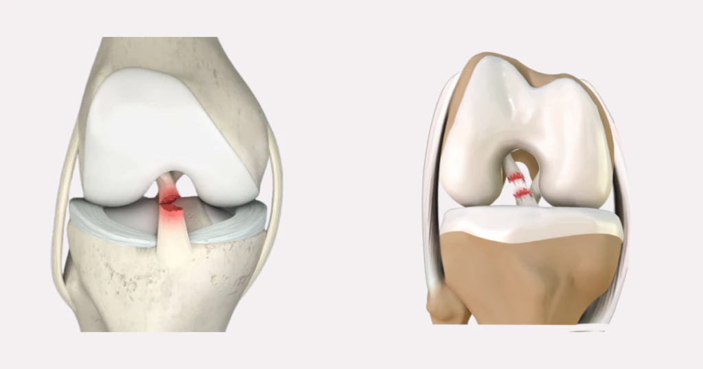 Đứt toàn phần và bán phần khác biệt ra sao Phân loại tổn thương và hệ quả điều trị