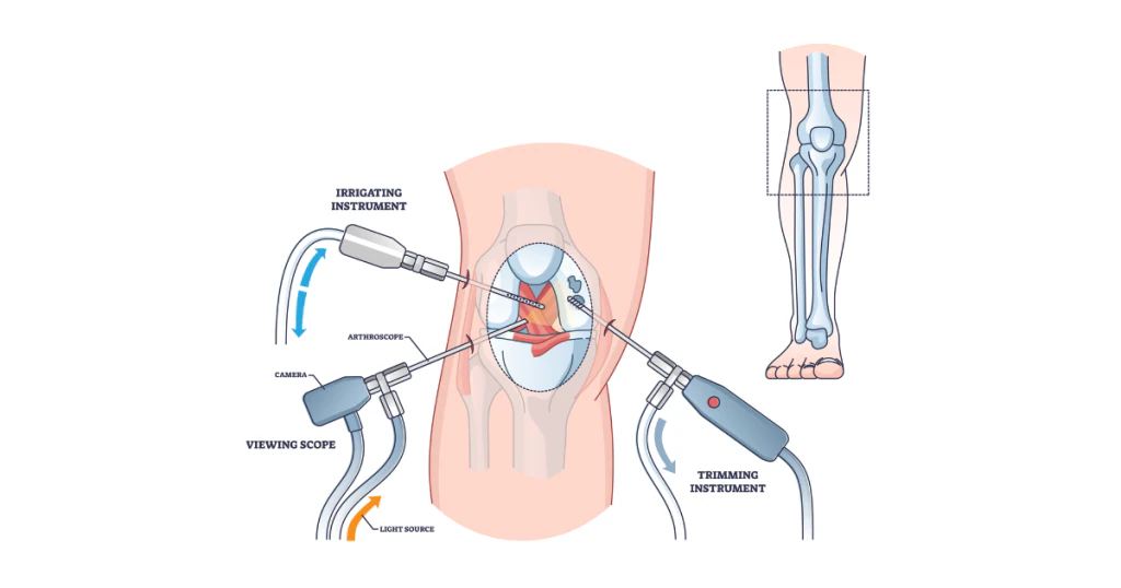 Ưu điểm của phẫu thuật nội soi khớp gối trong tái tạo dây chằng chéo trước (ACL)