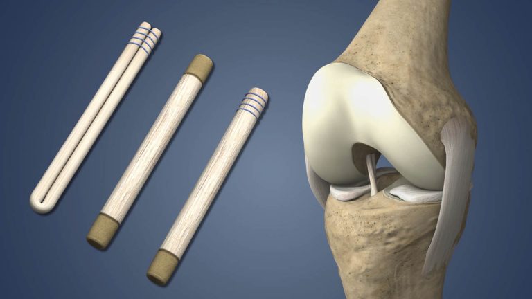 Tái tạo dây chằng khớp gối bằng gân tự thân