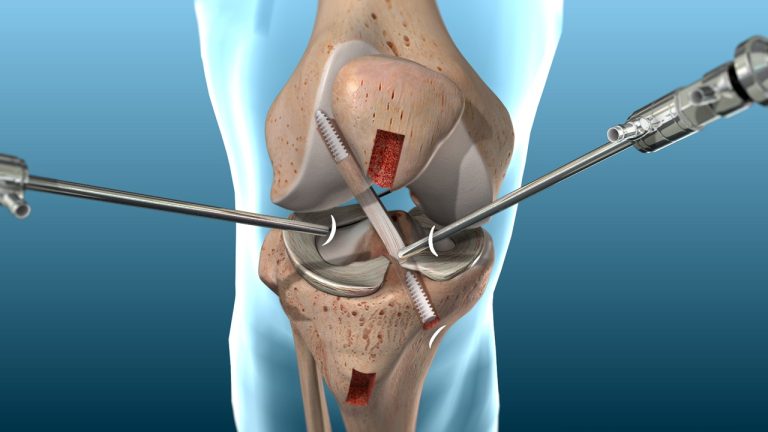 Tái tạo dây chằng khớp gối bằng dây chằng tự thân
