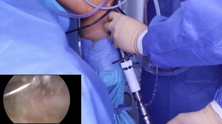 Qua trình tiến triển của gân tự thân