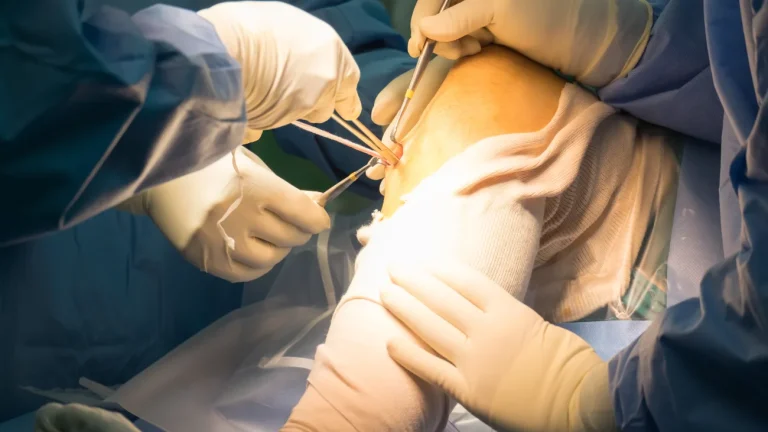Tái tạo dây chằng chéo trước bằng mảnh ghép gân bánh chè