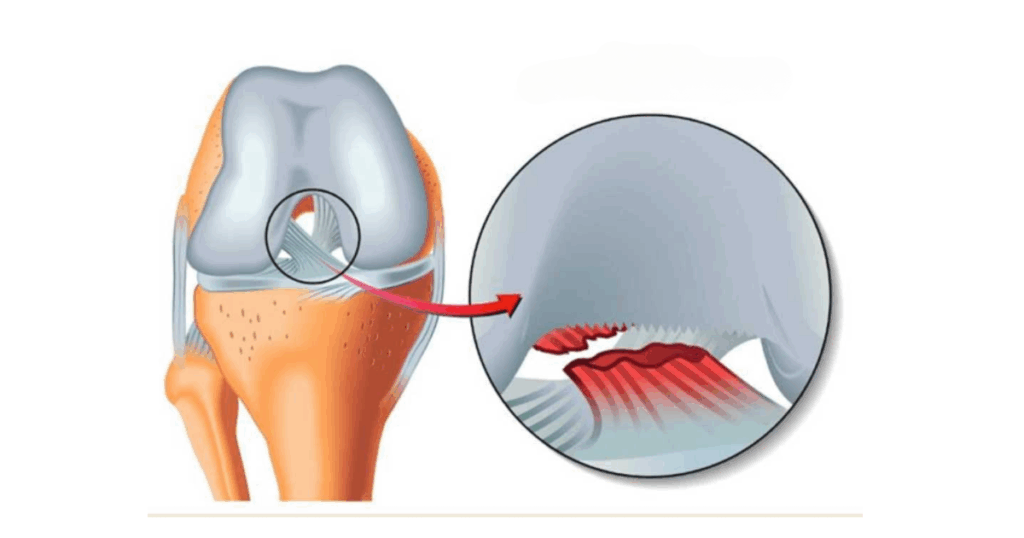 Dây chằng chéo trước (ACL) hoạt động khi nào