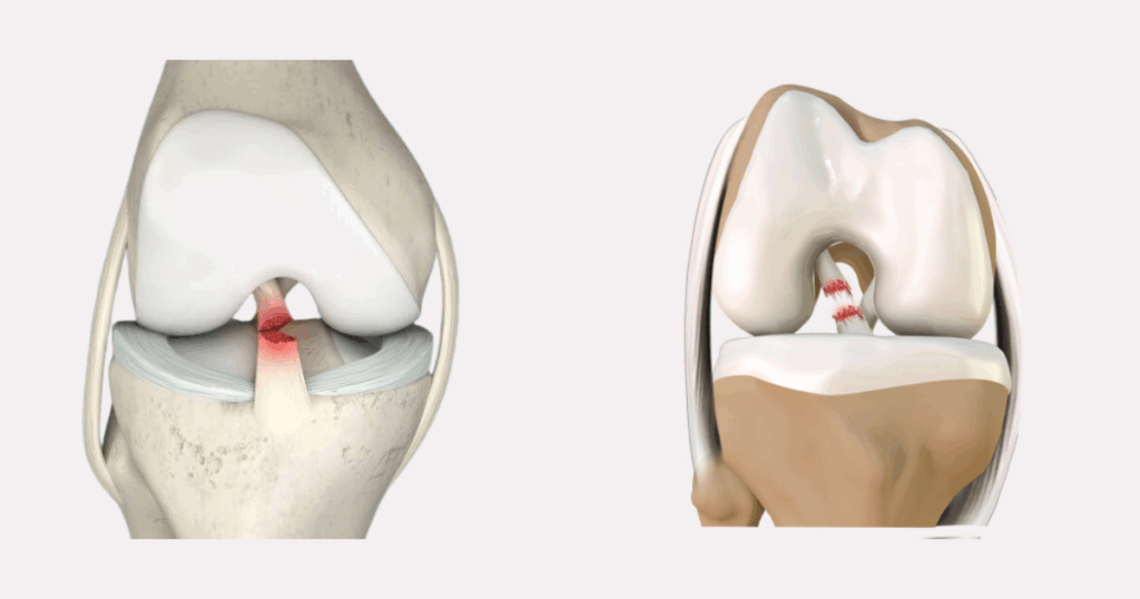 Đứt toàn phần và bán phần khác biệt ra sao Phân loại tổn thương và hệ quả điều trị