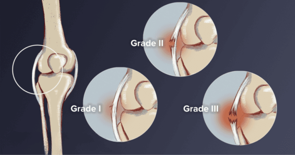 Hiểu rõ về các mức độ tổn thương dây chằng Giãn, rách, đứt