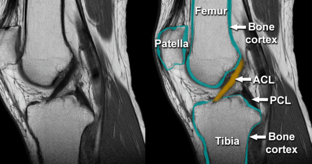 Khi nào nên chụp MRI chẩn đoán đứt dây chằng khớp gối