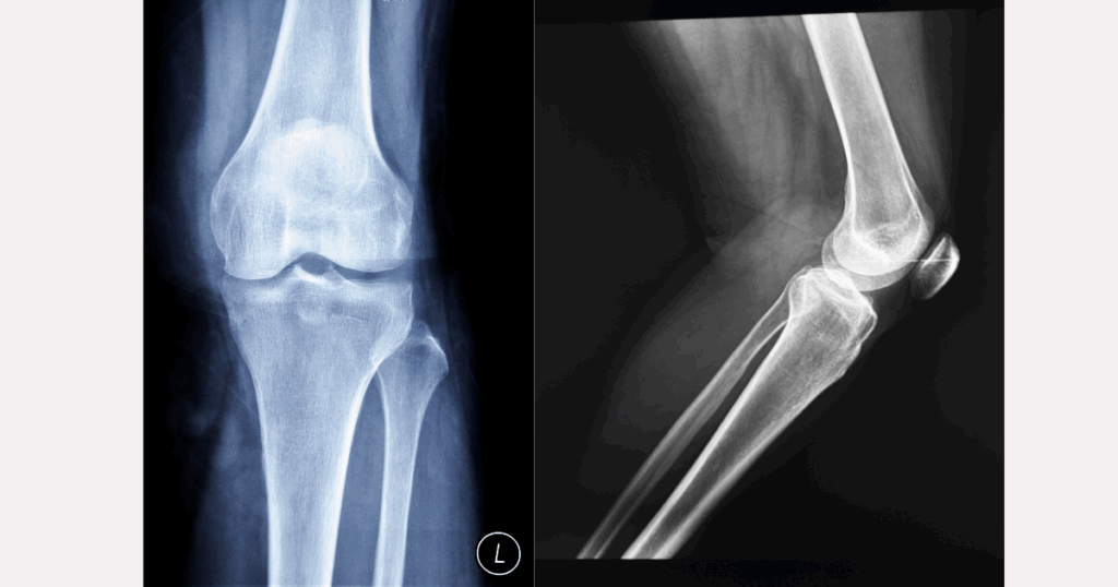 Vì sao X-quang không giúp chẩn đoán đứt dây chằng