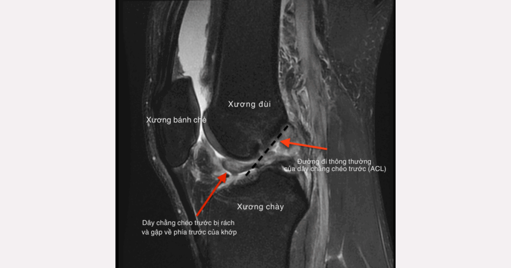 chẩn đoán tổn thương dây chằng chéo trước (ACL)