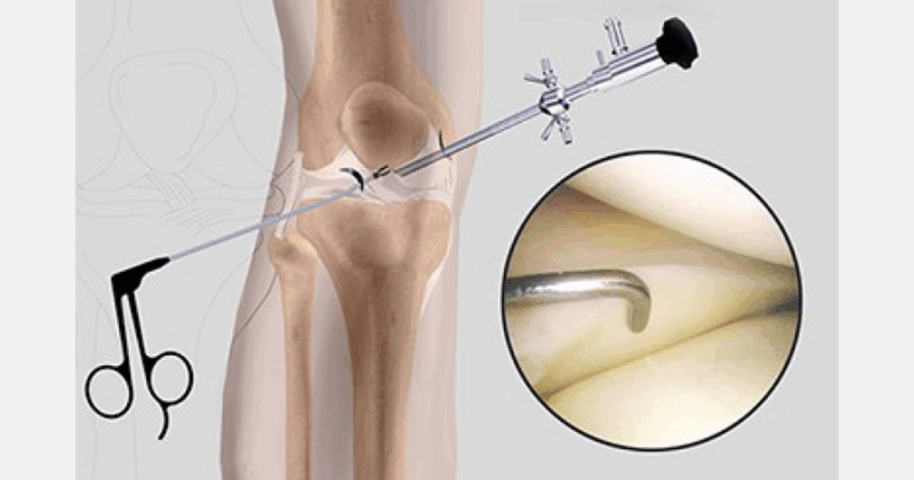 Khi nào cần nội soi chẩn đoán tổn thương ACL