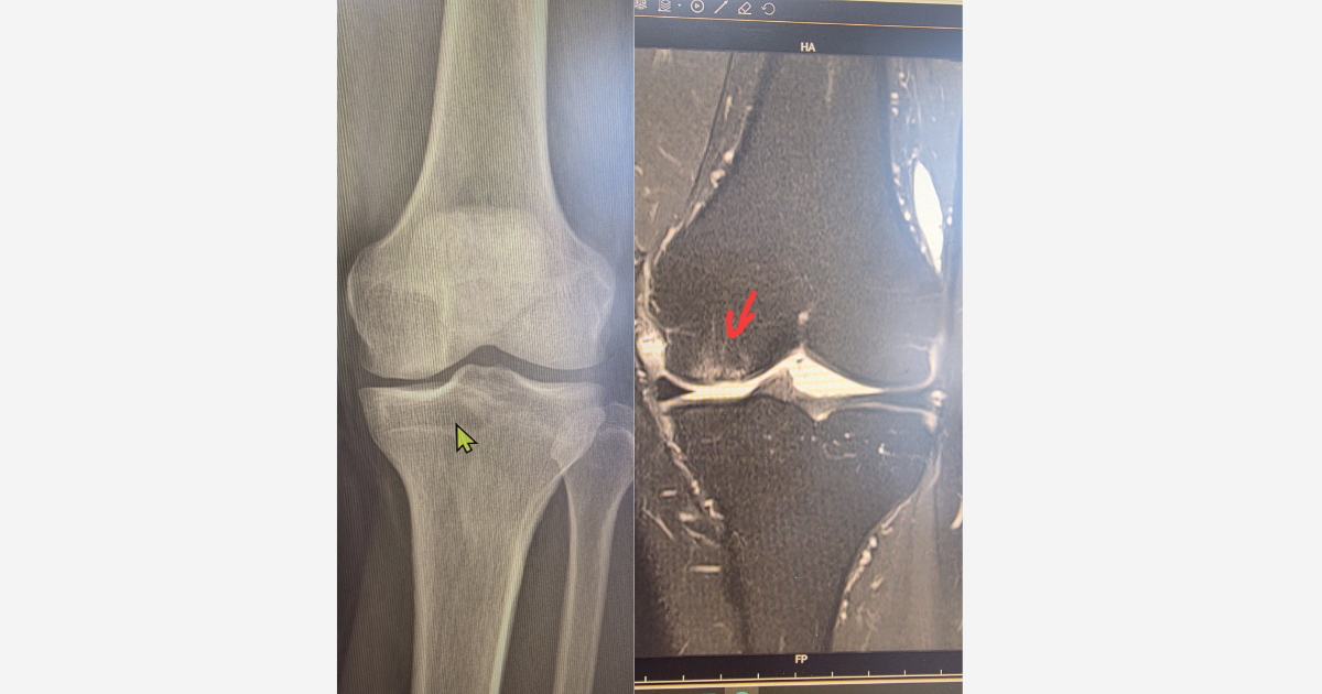 Ca lâm sàng sau 3 năm ghép sụn khớp nhân tạo