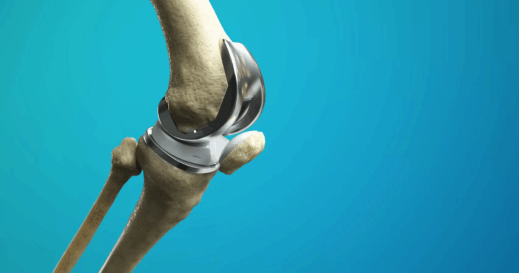 Quy trình và tiên lượng sau thay khớp gối toàn phần