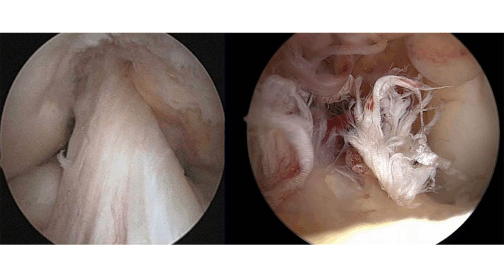 Tái đứt dây chằng chéo trước khớp gối nên xử lý như thế nào