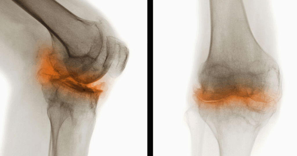 điều trị thoái hóa khớp gối theo từng giai đoạn bệnh