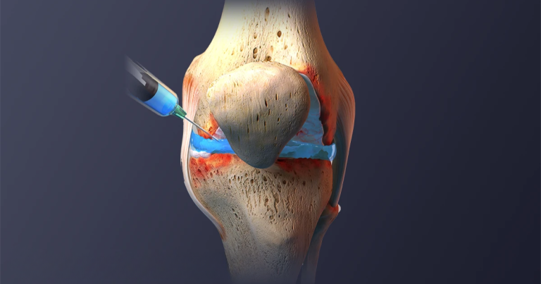 tiêm tại chỗ trong điều trị thoái hóa khớp gối