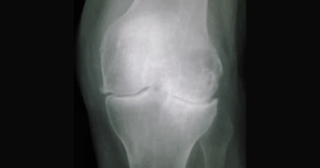 Hình ảnh đặc trưng của thoái hóa khớp gối trên X-quang
