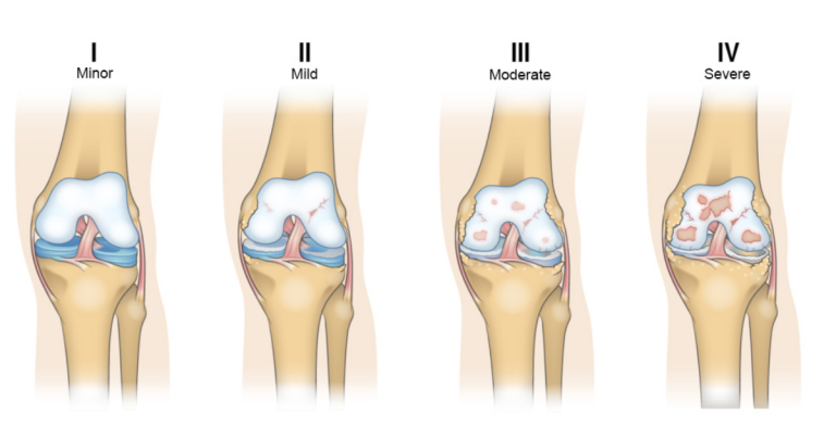 Các giai đoạn của thoái hóa khớp gối và ý nghĩa trong điều trị