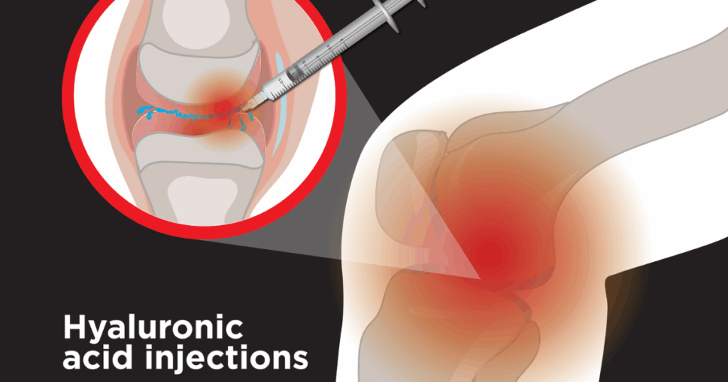 Hyaluronic Acid là gì và vì sao được dùng trong điều trị thoái hóa khớp