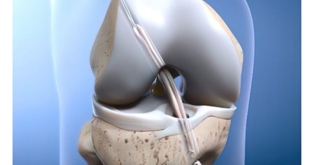 Những dấu hiệu sớm cho thấy dây chằng nhân tạo hoạt động tốt sau mổ