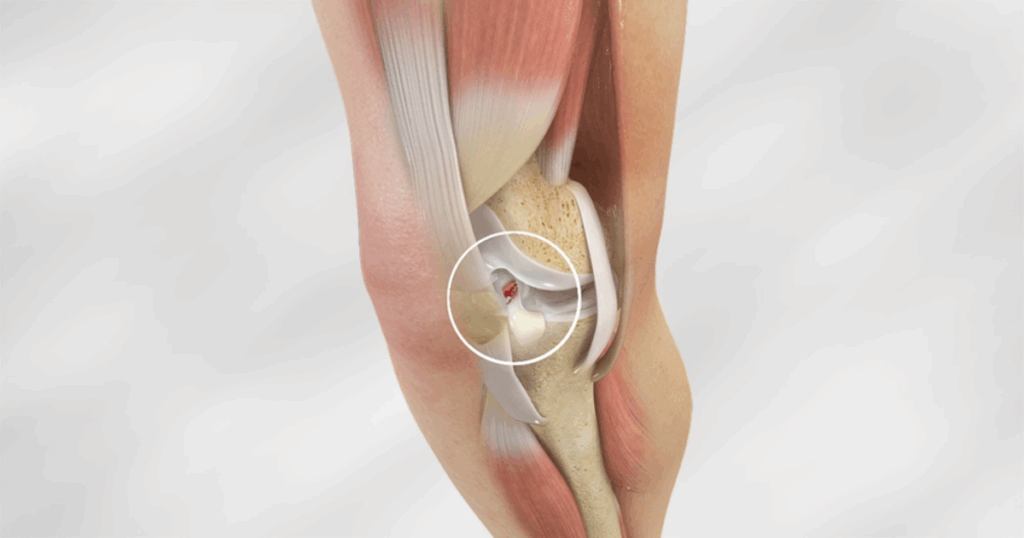 Tái đứt ACL sau mổ lần 1