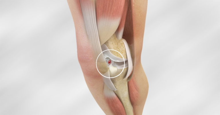 Tái đứt ACL sau mổ lần 1