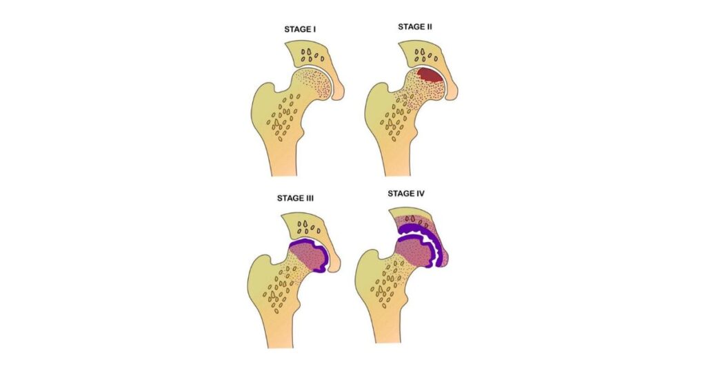 Hoại tử chỏm xương đùi Dấu hiệu sớm và nguy cơ sụp chỏm