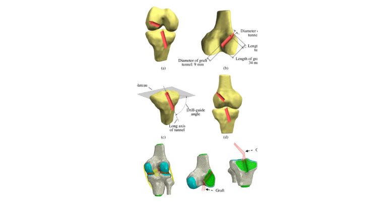 Vị trí đường hầm trong phẫu thuật dây chằng gối