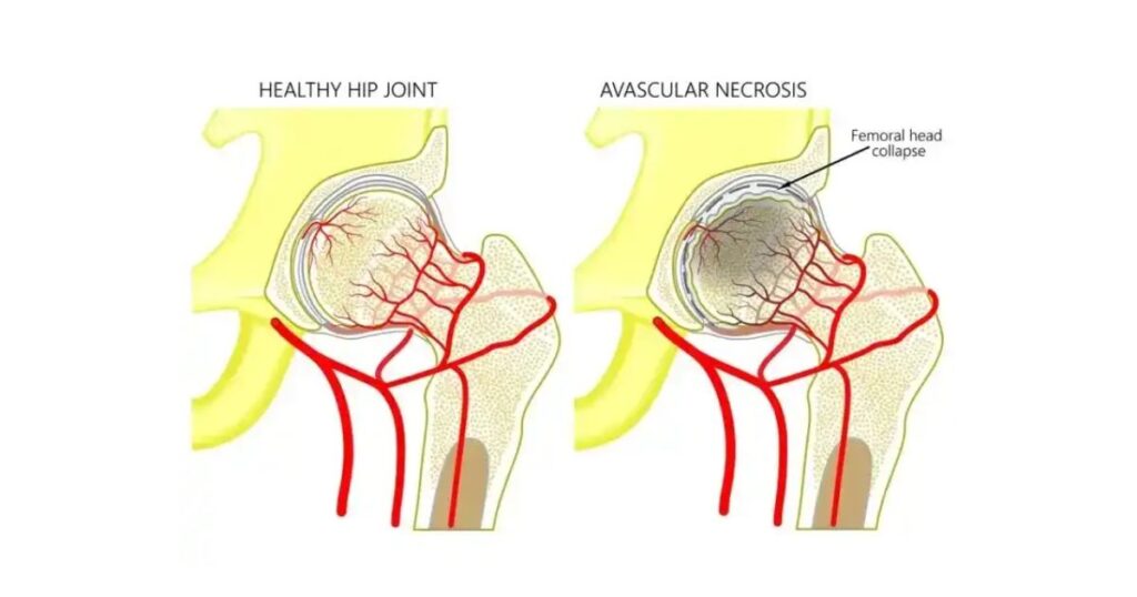 hoại tử chỏm xương đùi