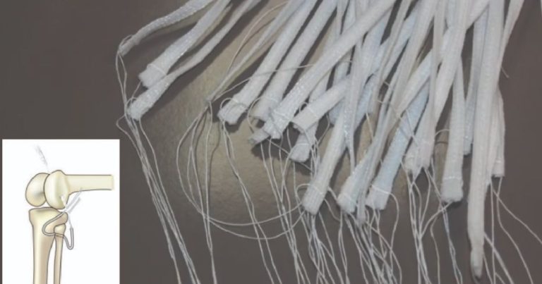 Các loại dây chằng nhân tạo trong mổ tái tạo dây chằng khớp gối