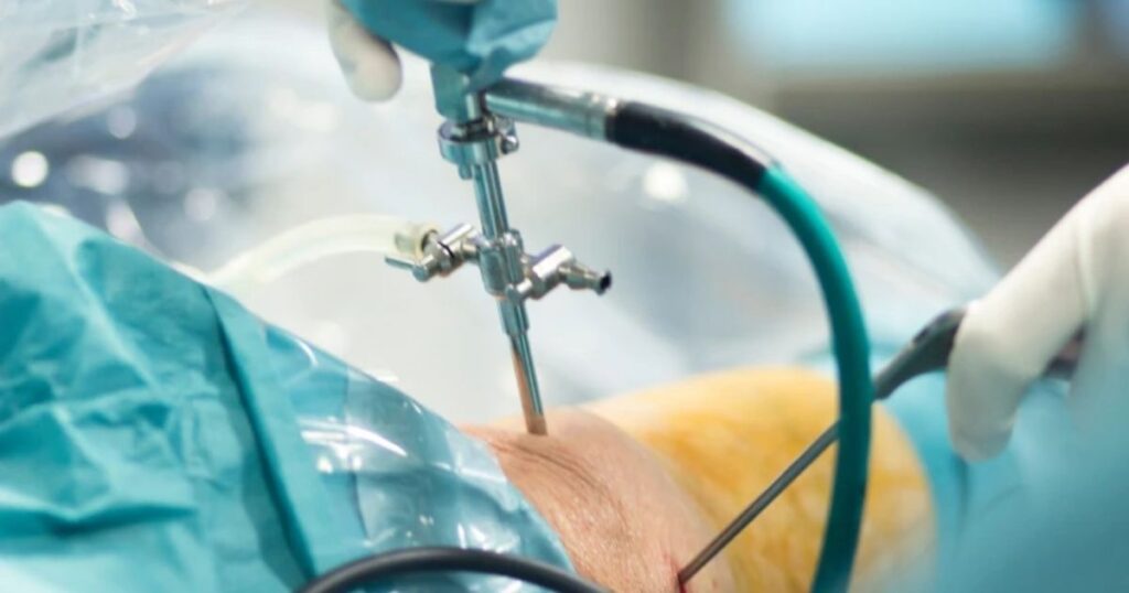 Có nên mổ dây chằng nhân tạo khớp gối không (2)