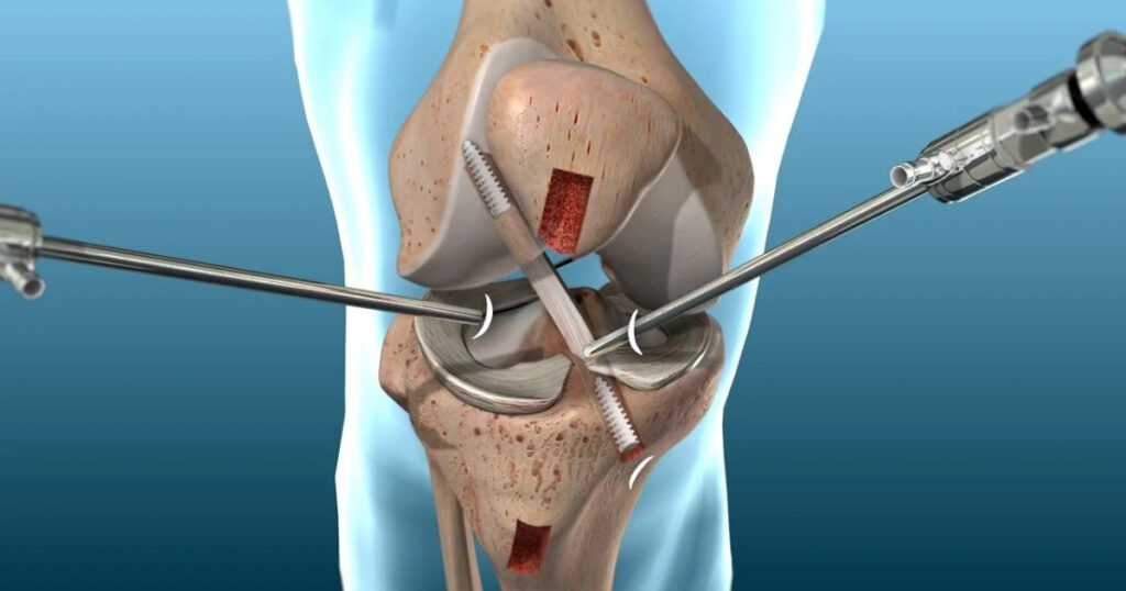 Nhược điểm của dây chằng nhân tạo trong phẫu thuật tái tạo dây chằng khớp gối