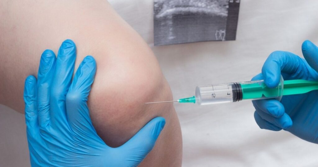 Thoái hóa khớp gối mức độ bao nhiêu thì nên tiêm chất nhờn (1)